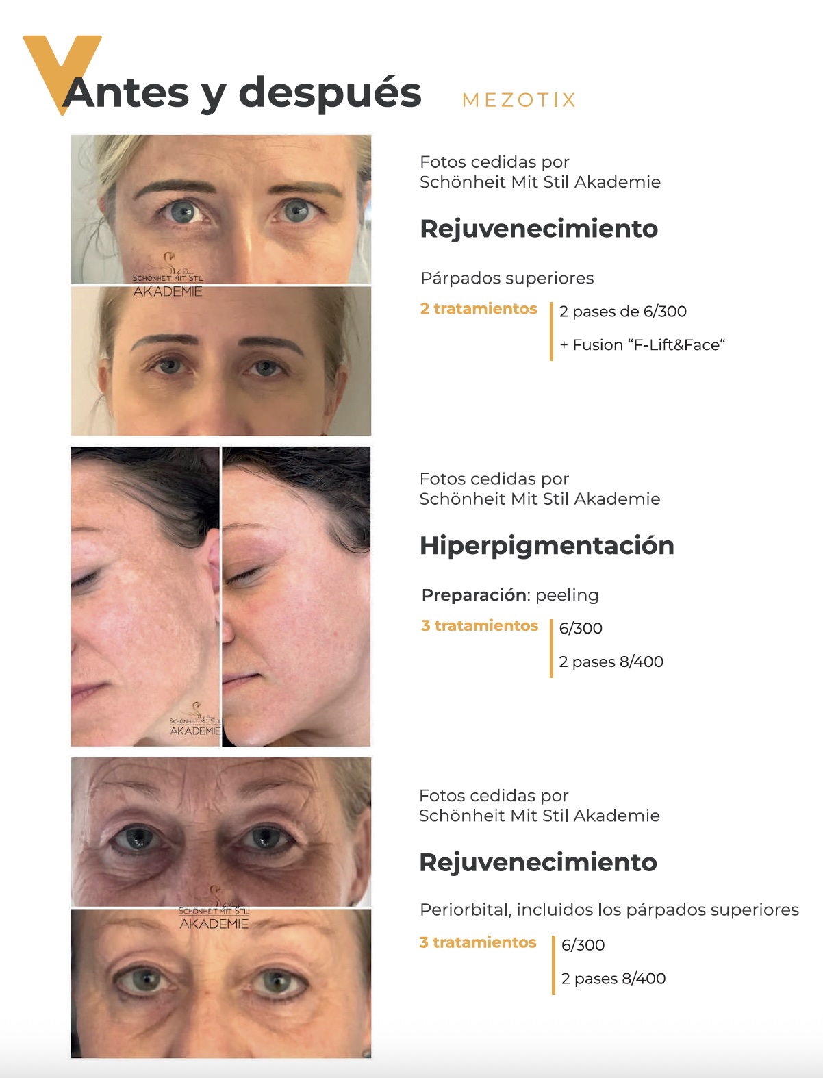 antes y despues con mezotix 1