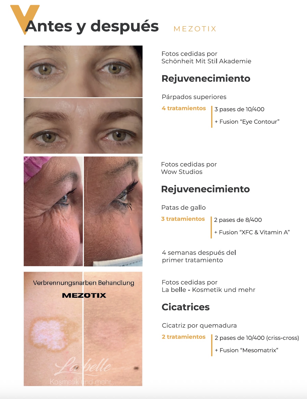 antes y despues con mezotix 2